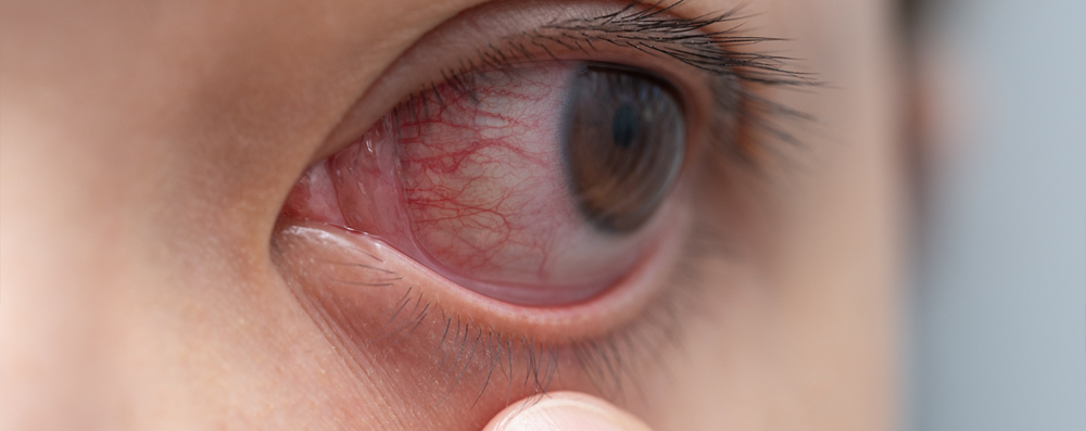 3 Signs You Need an Eye Exam