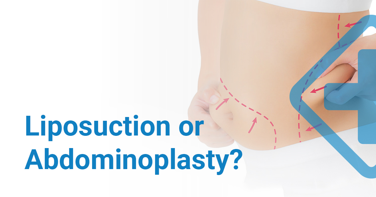 Liposuction or Abdominoplasty?