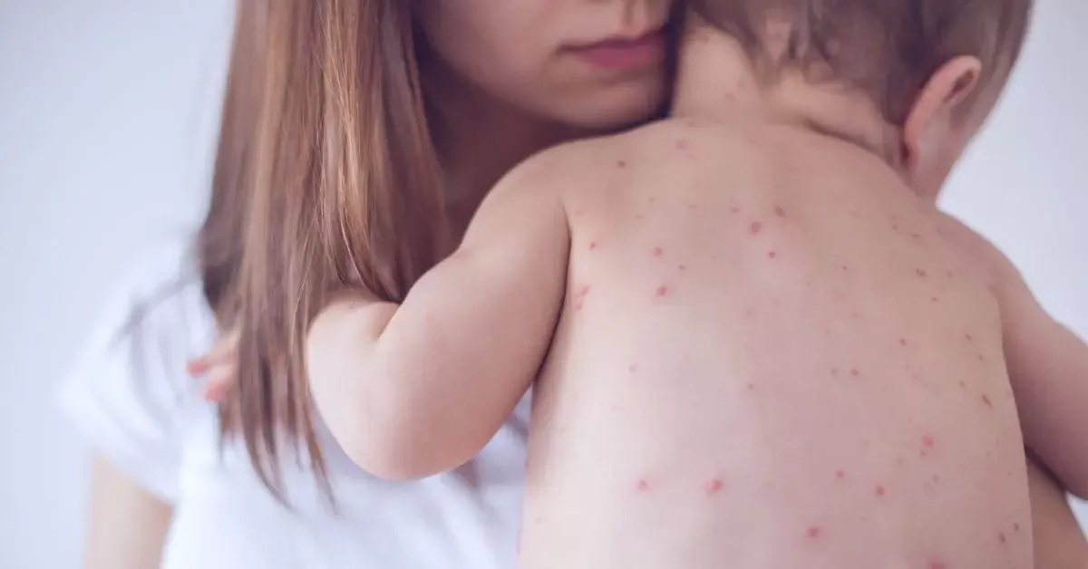Measles in Children: Symptoms, Treatment & Prevention