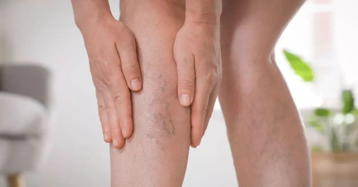 Deep Vein Thrombosis (DVT): Symptoms, Causes & Treatment