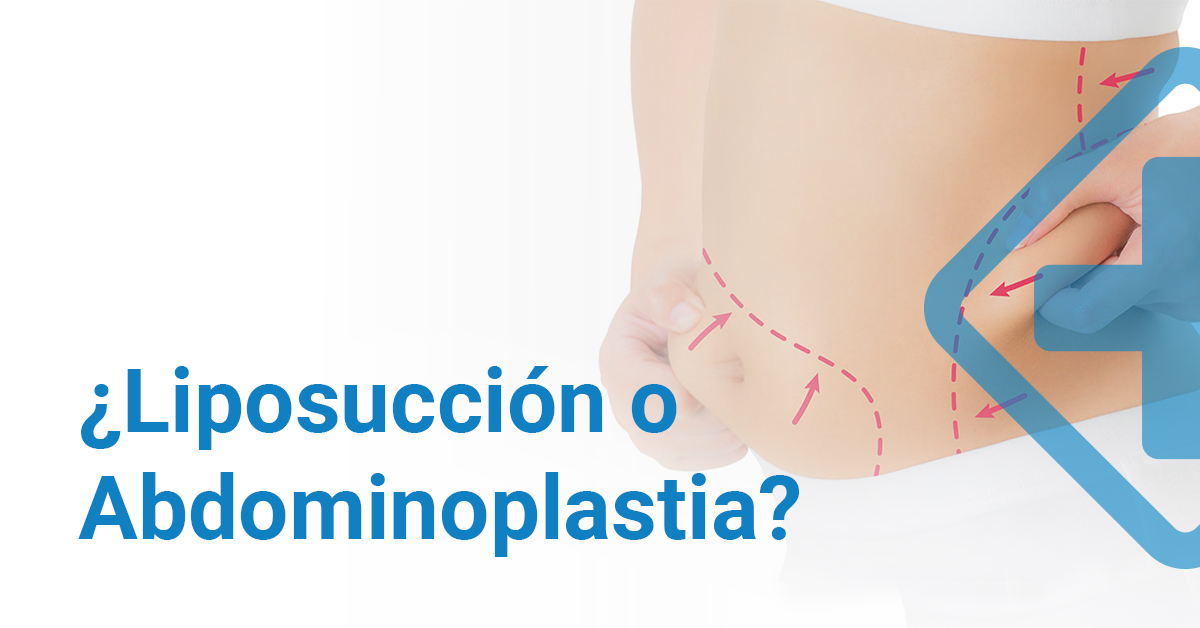 ¿Liposucción o Abdominoplastia?