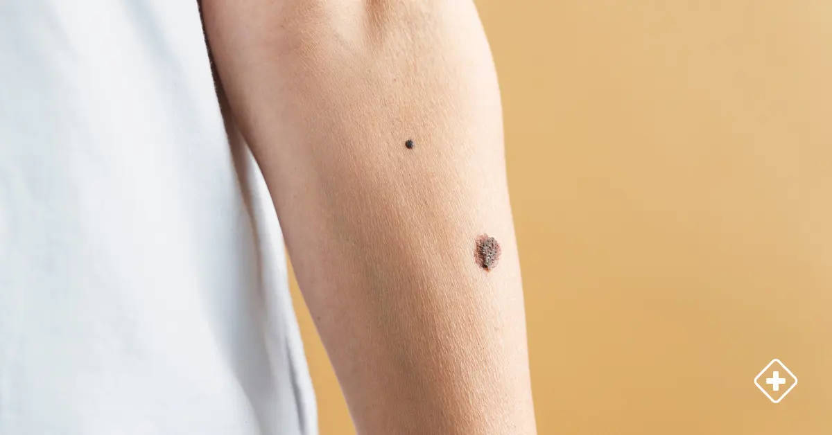 ¿Lunar o Melanoma?